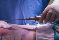 Compare Liposuction and Lipomatic