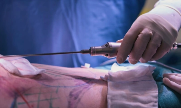 Compare Liposuction and Lipomatic
