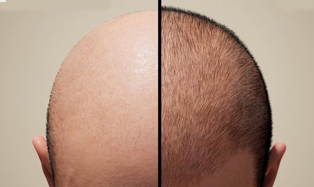 What is a Hair Transplant?