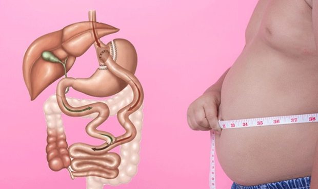 عوارض بای پس معده را قبل از جراحی بشناسید عوارض بای پس معده را قبل از جراحی بشناسید