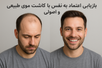 بازیابی اعتماد به نفس با کاشت مو طبیعی و اصولی